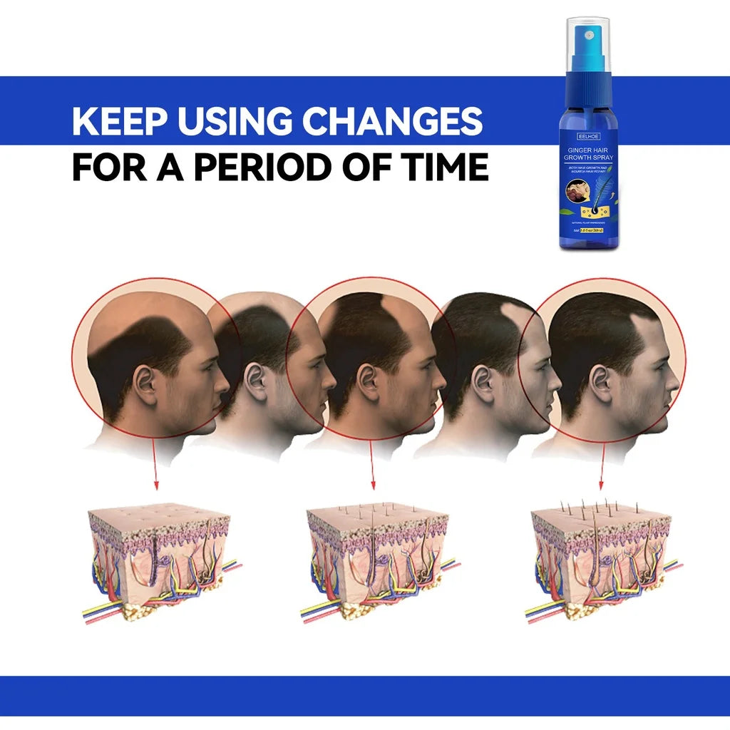 Ginger Hair Growth spray Anti Hair Fall Hair Loss Treatment Hair Growth Essence Oil for Men Women hair treatment - Kimlud
